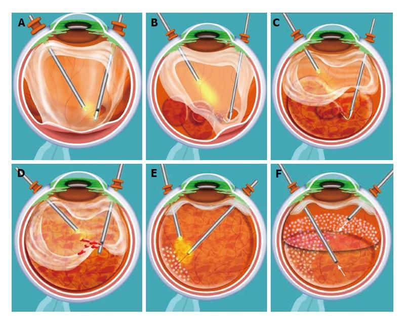 Vitreoretinal Surgery